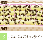 阪南市 エステサロン 痩身  老廃物でガチガチになりセルライト化した脂肪細胞。（ラジオ波 痩身トリートメントの流れ）