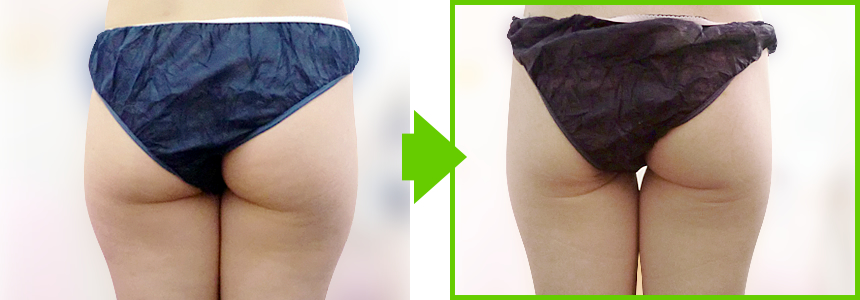 ラジオ波トリートメントで劇的脚やせ。スラッと伸びた美脚を目指すなら阪南エステサロン「manomano(マノマノ）」へ